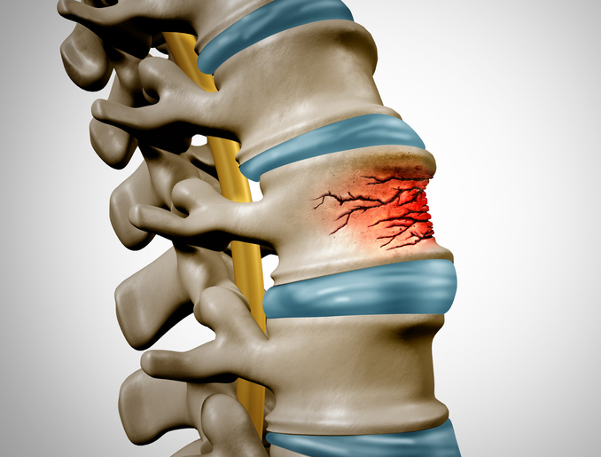 Compression Fractures