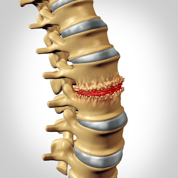 Degenerative Disc Disease