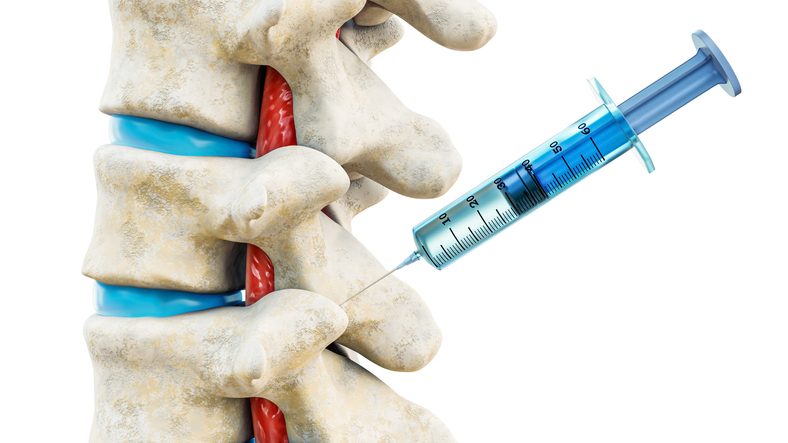 Facet Joint Syndrome