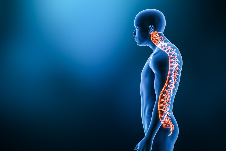 Kyphosis