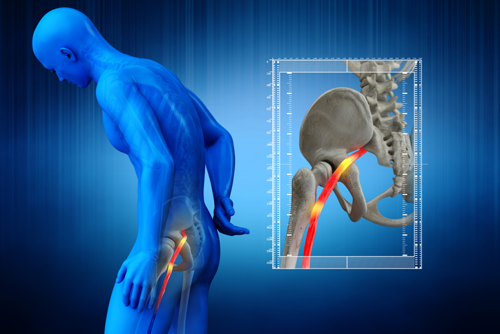 Lumbar Radiculopathy