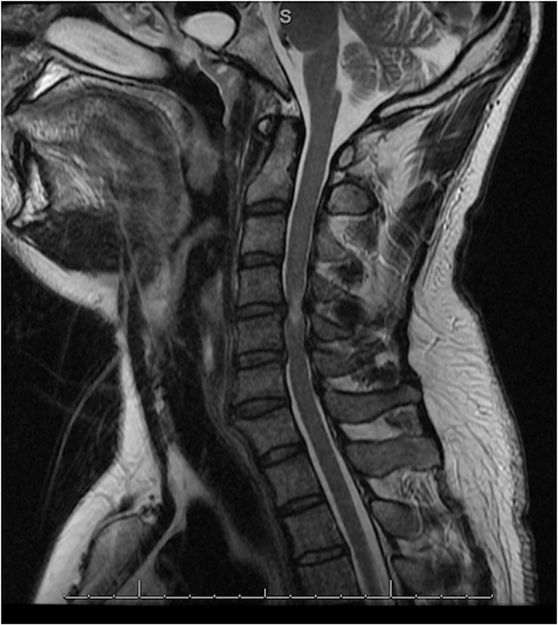 Myelopathy