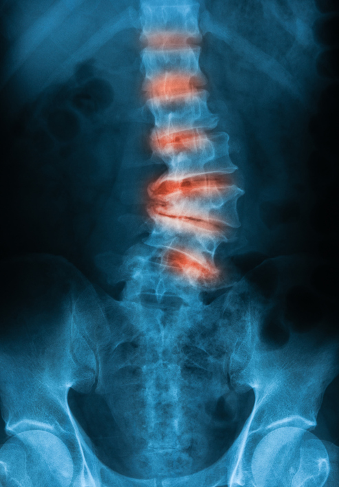Osteoarthritis of the Spine