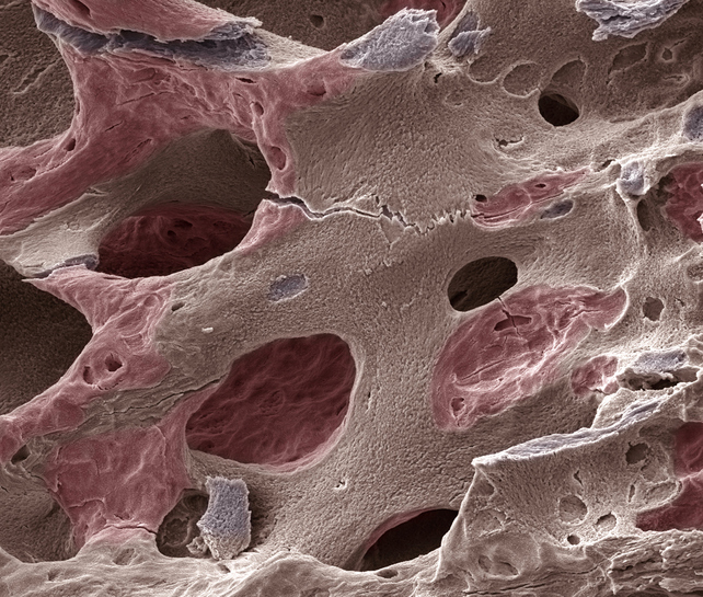 Osteoporosis of the Spine