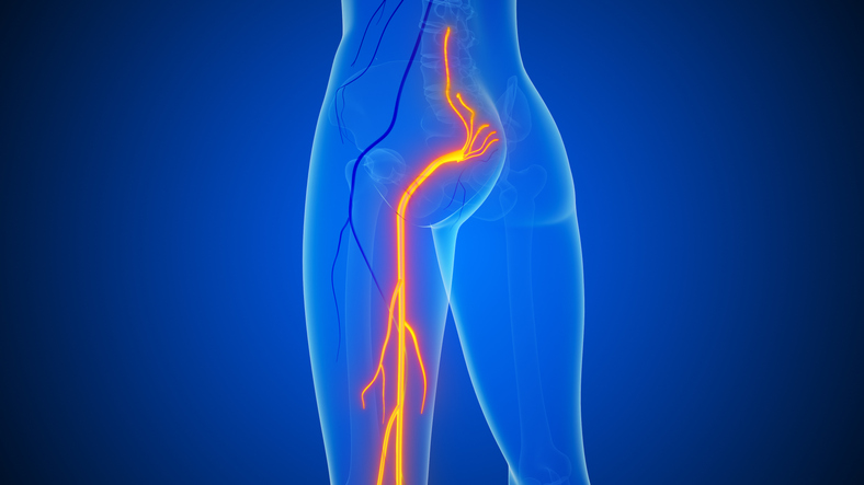 Sciatica