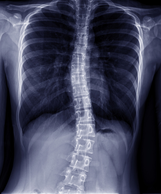 Scoliosis