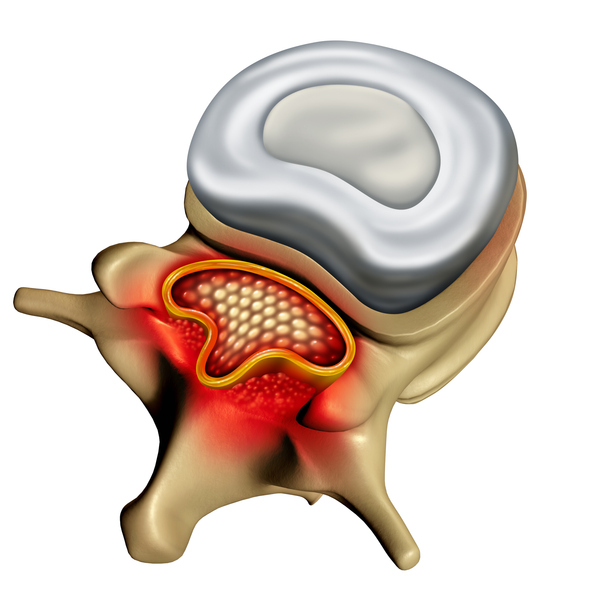 Spinal Stenosis
