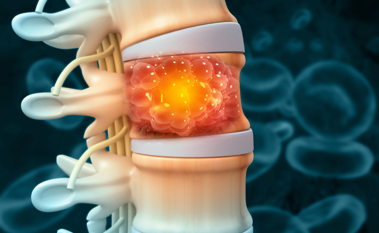 Spinal Tumors