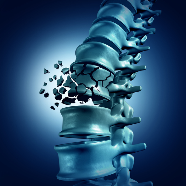 Spinal Fractures